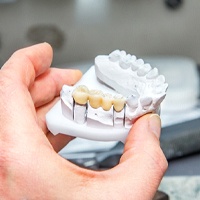 Dental bridge in Carlisle on clay model