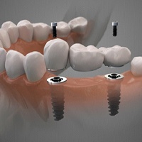 Dental implant bridge in Carlisle
