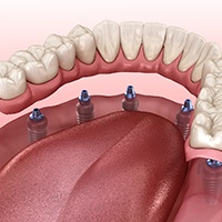 implant dentures more expensive than cost of dentures in Carlisle