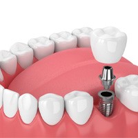 3D graphic of dental implants