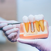 Dentist pointing to a model of a dental implant