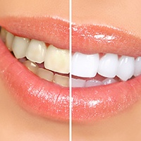 A before-and-after photo of teeth whitening in Carlisle