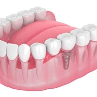 Illustration of single dental implant