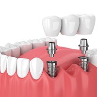 Illustration of implant bridge