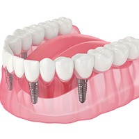 Illustration of implant denture