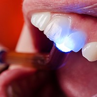 Dental light hardening cosmetic bonding