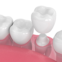 Illustration of dental crown in Carlisle being placed on tooth