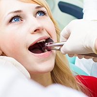 A woman having a wisdom tooth extracted