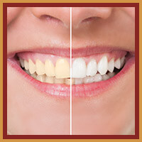 Teeth whitening before and after smile