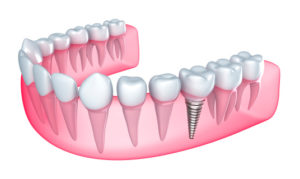 Care for Dental Implants with Tips from Your Carlisle Dentist