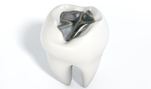 tooth crown with silver filling