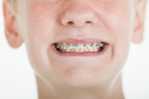 Teen wearing braces.