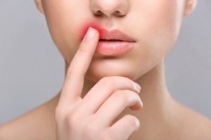 Woman with a red spot on her lip and her finger is touching it. 