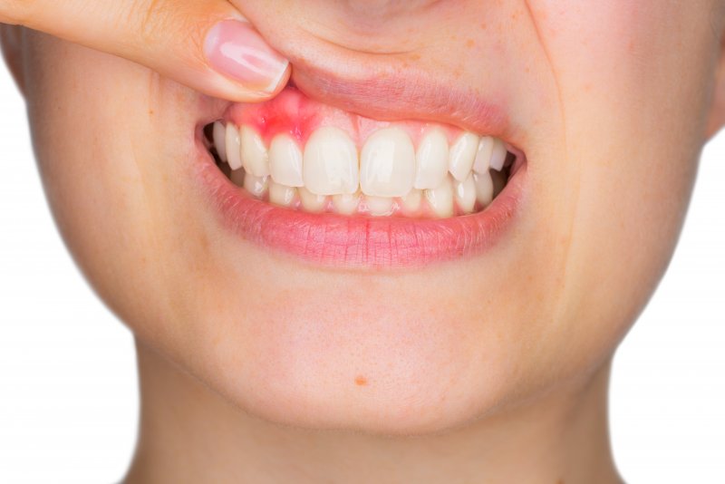 person pointing at red and inflamed gums