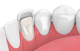 Image of porcelain veneers being placed on teeth. 