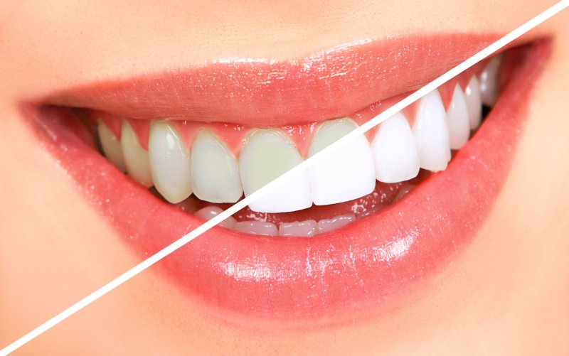 Smile before and after using teeth whitening products