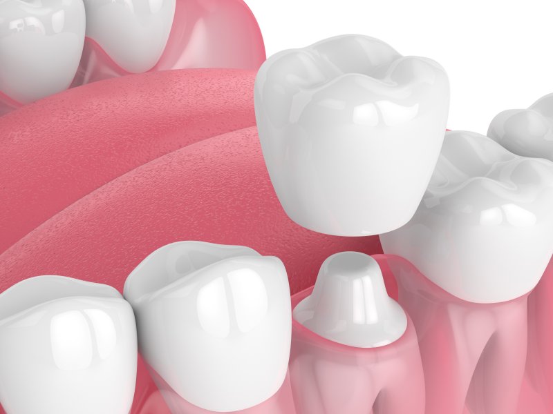 3D illustration of a dental crown