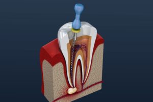 Root canal on infected tooth