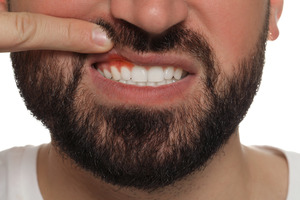 Man pulling up lip to show inflamed gums