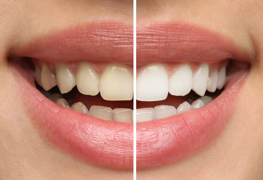 Close up of woman's smile with half yellow, half white teeth