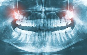X-ray of patient's teeth with upper wisdom teeth highlighted red